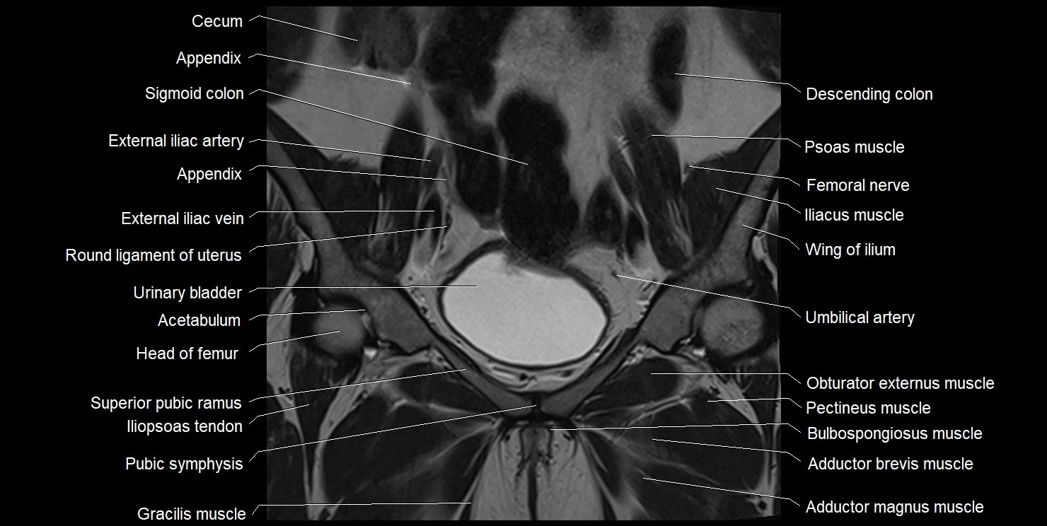 female pelvis coronal cross sectional anatomy image 12.webp